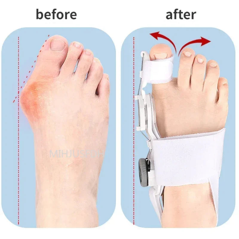 Bunion Corrector & Toe Straightener – Adjustable 3D Support Brace with Silicone Pad, ABS Splint & Comfort Straps for Pain Relief (Hallux Valgus, Big Toe Alignment)