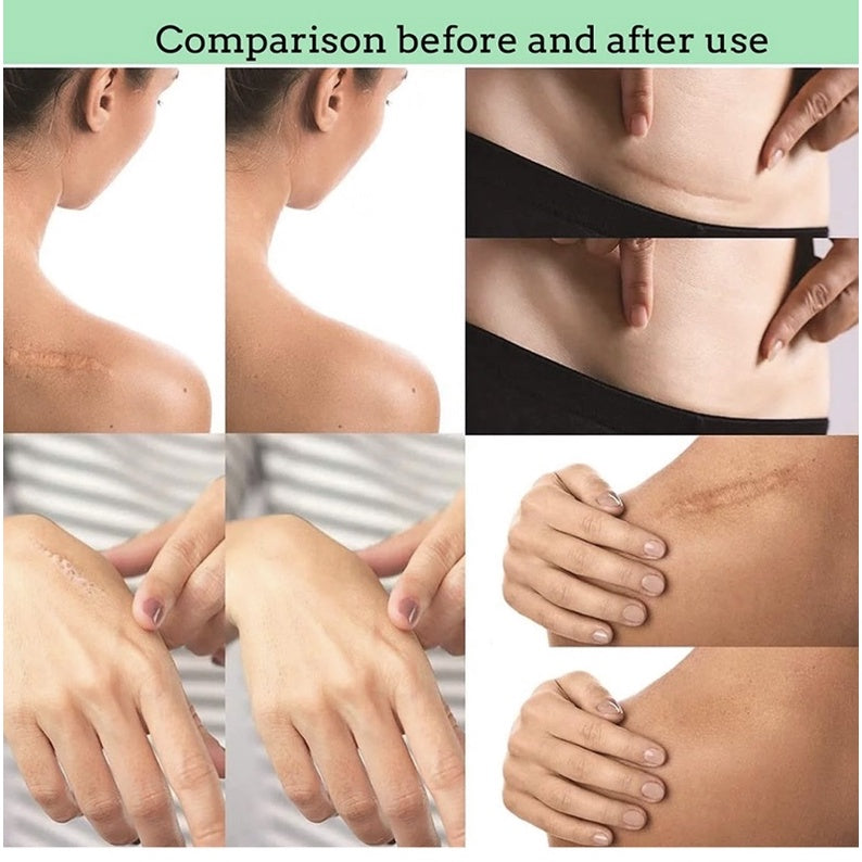 Reusable Silicone Scar Treatment Strips - Professional Quality Scar Reduction Tape for Surgical, C-Section & Injury Scar