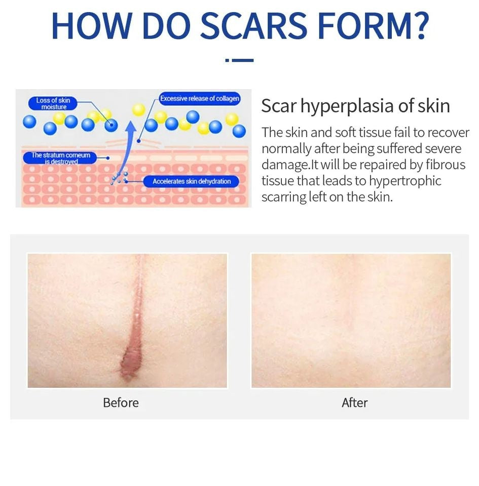 Reusable Silicone Scar Treatment Strips - Professional Quality Scar Reduction Tape for Surgical, C-Section & Injury Scar