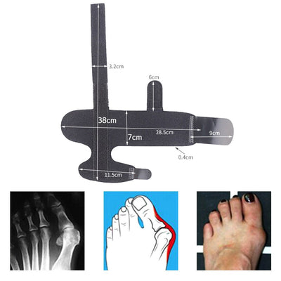 Bunion Corrector Splint Straightener Support Toes Foot Thumb Orthosis Hallux Valgus Corrector Orthopedic Tools  1 Pair