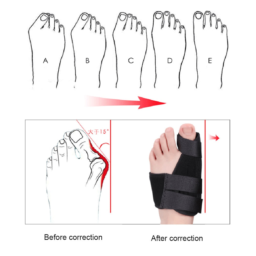 Bunion Corrector Toe Separator Splint Correction System Device Hallux Valgus Foot Care Pedicure Orthotics Hammer Crooked Big Toe Straightener Straightening Separator Bunion Relief Foot Sleeves